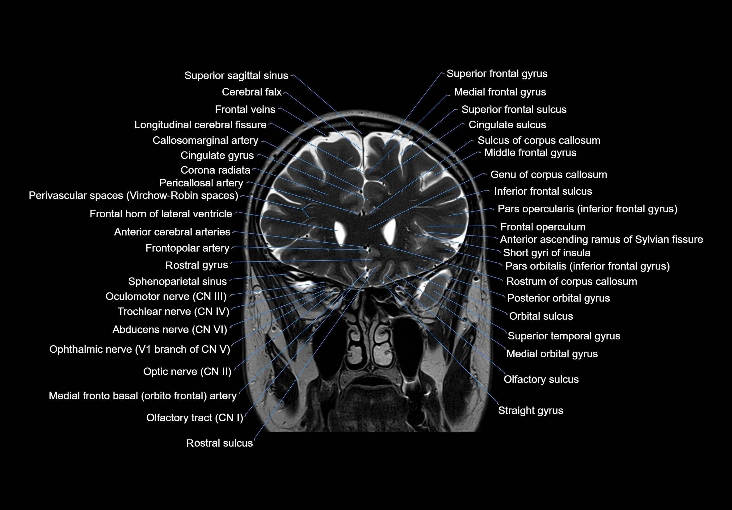 MRI Brain coronal cross sectional labelled anatomy 3T image  -img-00001-00023.webp